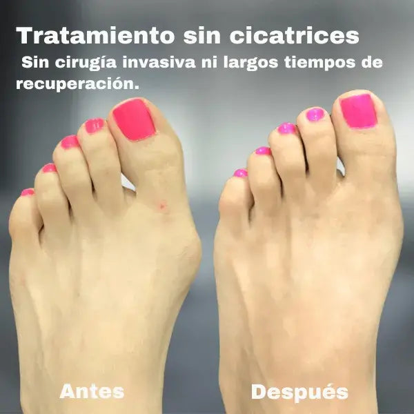 Corrector ortopédico premium para juanetes + bisagra patentada +ajuste ergonómico